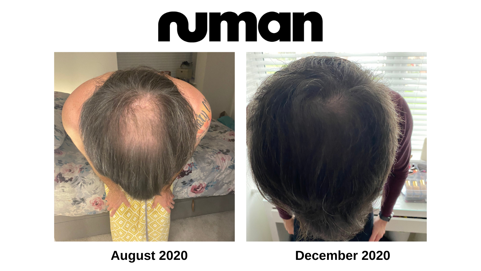 Numankind James hair regrowth story